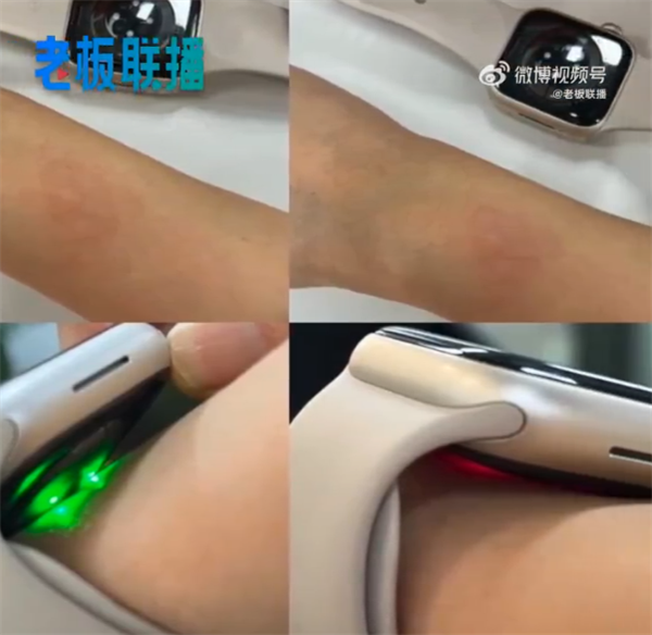 苹果Apple Watch S8佩戴引发手腕红肿	？苹果客服回应：与皮肤敏感度有关。