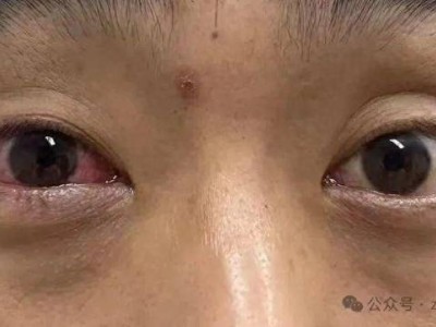 户外探险遇五步蛇，男子好奇捕捉反遭毒液喷眼！