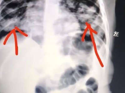 一岁宝宝误服紫草油，家长手抠催吐致肺部感染，医生提醒慎处理